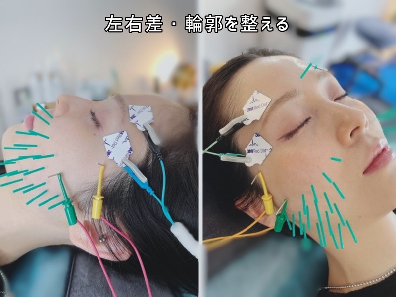 渋谷・表参道 美容鍼 小顔｜AOYAMA SALON YZ