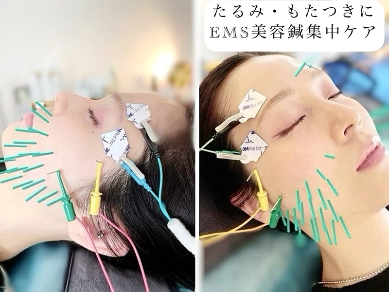 渋谷・表参道 美容鍼 小顔｜AOYAMA SALON YZ