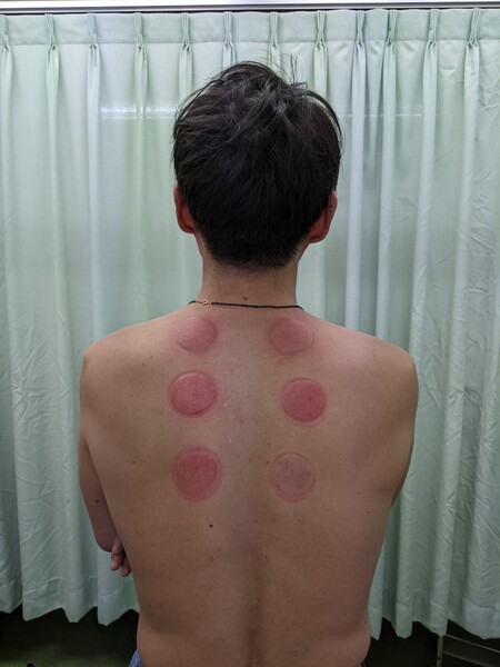 短時間 低周波+吸い玉コース