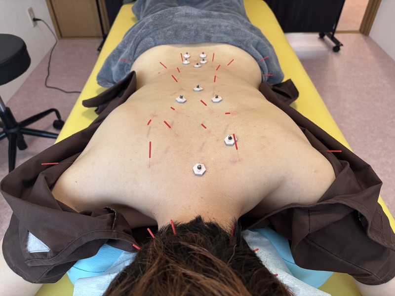 【１番人気】鍼灸治療60分コース