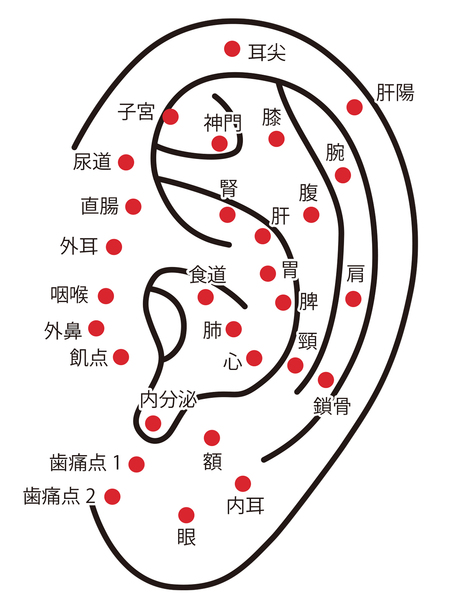 耳鍼